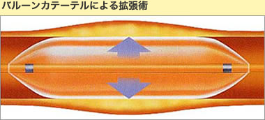 バルーンカテーテルによる拡張術