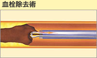 血栓除去術