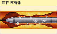 血栓溶解術
